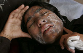 Pakistani Girl Injured Acid Attack
